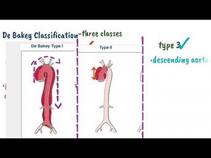Understanding Stanford and De Bakey Classification for Aortic dissection