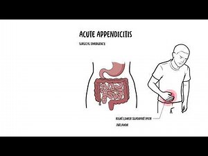 What Is Appendicitis? Symptoms, Causes & Treatment Explained • Video • MEDtube.net