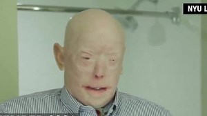 Firefighter recovering from historic face transplant surgery
