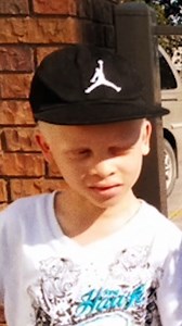 I never knew what albinism was - until I had my kids 🤍 #fbreels #borndifferent #albinism #albinismawareness #parenting #siblings | Born Different