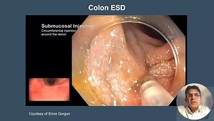 Endoscopic Resection of Early Colorectal Neoplasia