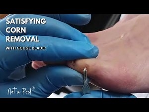 Satisfying Corn Removal on Little Toe With Gouge Blade | Foot Health Practitioner, Not A Pod. UK