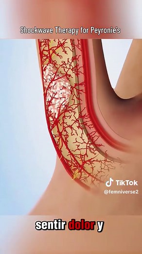 ​Shockwave Therapy for Peyronie's: How It Works ⚡️#learnontiktok | peyronie solución