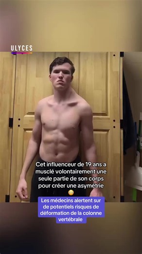 Muscle asymétrique : risque de déformation de la colonne