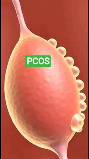 PCOS Explained in 3D | How Cysts Form & Hormones Get Imbalanced #pcos #pcosinfertility