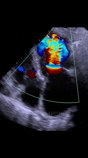 Echocardiogram explained: what an echo shows and how it works