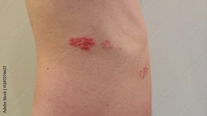 Close-up of shingles rash and blisters on the right side, back, and belly of a 45-year-old Asian man’s torso, showing symptoms of a viral skin infection