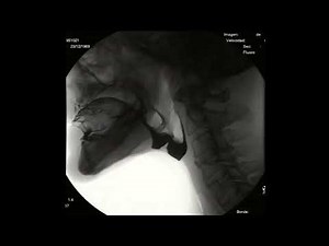 Videofluoroscopic Swallowing Study (VFSS) - Videofluoroscopía de deglución