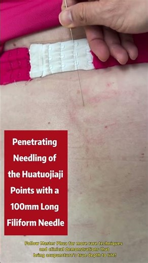 Penetrating Needling of the Huatuojiaji Points with a 100 mm Long Filiform Needle