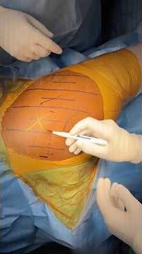 How small is the cut-mini incision posterior for Hip Replacement ? #totalhipreplacement