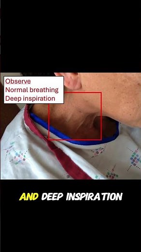 🔍 Kussmaul’s Sign | Elevated JVP During Inspiration #cardiology #medicine #emergencymedicine #meded