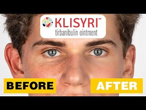 Klisyri: A topical chemotherapy drug that may reverse aging and improve hyperpigmentation