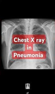 Chest Xray in Pneumonia #cxr #radiology