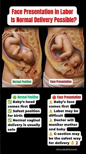 Normal vaginal Birth vs Face Presentation 😳 | Baby Position During Labor #shorts #pregnancy
