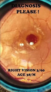 Diagnosis Plz | Macular hole | Smartphone Fundus Videography | Fundus Photography | Short Video 517