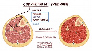 Video: Compartment syndrome - Video Explanation! | Osmosis | Osmosis