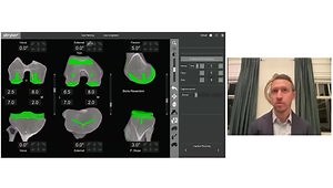 Mako SmartRobotics™ in My Practice