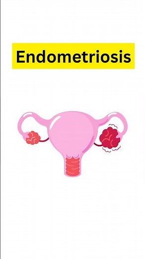 Endometriosis Symptoms Every Woman Must Know! #Endometriosis #PeriodPain #WomensHealth #PelvicPain
