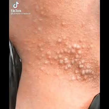 Cyst popping this week|| Ultimate compilation|| #cyst #popping