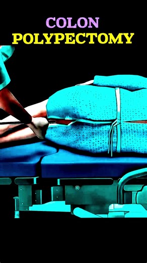 Colonoscopy (3D Animation) #colonoscopy #anesthesia #tools #life #3danimation