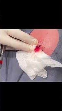 A LARGE PILAR CYST ON THE HEAD - REMOVAL OF PILAR CYST - HOW PILAR CYSTS ARE REMOVED