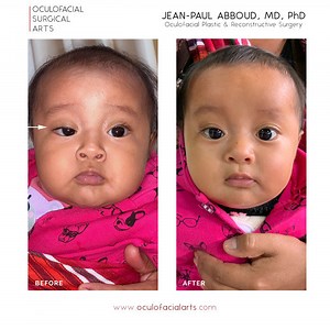 What is Congenital Ptosis (Eyelid Droop)?