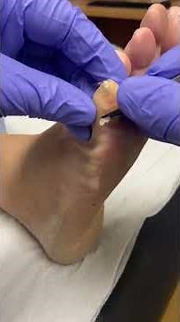 Watch how our expert podiatrist removes a corn on the little toe with ease!