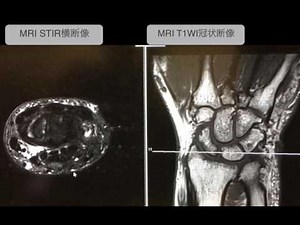 手根管症候群のMRI画像