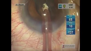 Fluidics of the Alcon Centurion Cataract Surgery System - Eyetube