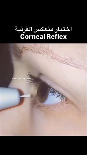 ‎ˢᵃᵇʳᶤᶰ| صابرينا‎ on Instagram‎: "Corneal Reflex ويُذكر كمان تحت : Brainstem reflexes Cranial nerve V & VII function طيب شو هو او شو معناه يا صابرينا ؟ اختبار منعكس القرنية: نلمس القرنية بلطف بقطنة الطبيعي: رمش العين (blinking) الأعصاب المشاركة: Afferent: العصب ثلاثي التوائم CN V (ophthalmic division) Efferent: العصب الوجهي CN VII أهميته بالتخدير: تقييم سلامة جذع الدماغ بيختفي بالتخدير العام والغيبوبة وشلل الأعصاب القحفية *****غير موثوق لتحديد عمق التخدير"‎