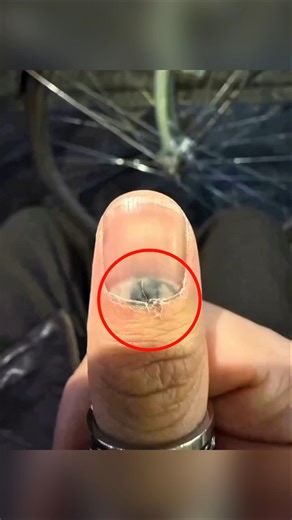 How Will This Man's Broken Fingernail Be Fixed #shortsvideo