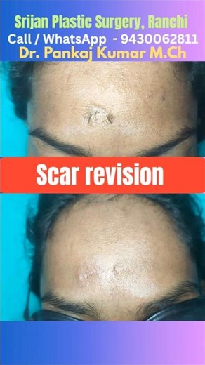 scar revision surgery -2 month follow up result| Scar revision surgery in Ranchi| abest scar result