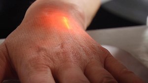 Co2 Fractional Laser Treatment Explained