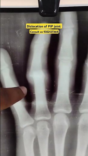 Ring finger PIP joint dislocation #physiotherapy#pain #splint #plaster #postoperative #ligament
