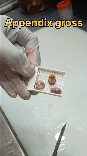 Appendix gross pathology 🤫| #histopathology #histomuseum #appendix #appendicitis #appendixsurgery