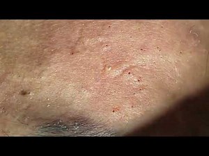 Deep Acne blackhead Extraction From Face, lip and chin NEW