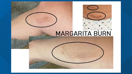 'It's not dangerous, but if you're drinking a lot of margaritas on vacation, you're at risk'