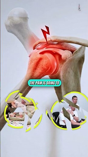 Shoulder Bursitis Is Not Just Inflammation