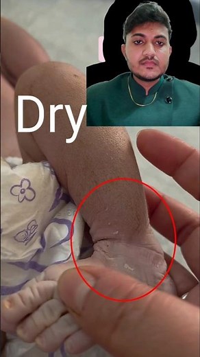 Post term pregnancy #pregnancy #babybirth #csection #amnioticfluid