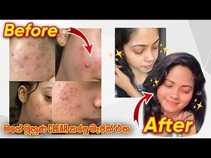 මාසෙකින් pimples නැති කරපු මැජික් එක 🧏🏻‍♀️✨ #vlog #skincare #clearskin