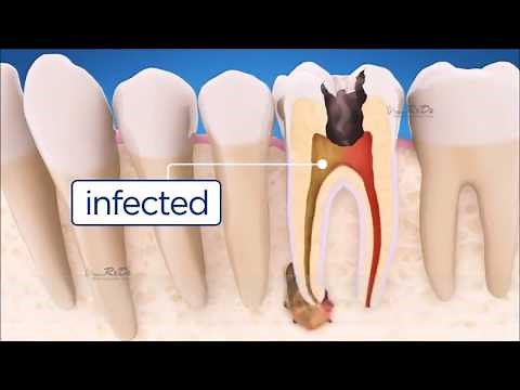 Types of Dental Procedures - RxDx Bangalore