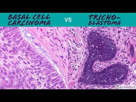 Hair Follicle Tumors vs Basal Cell Carcinoma Made Simple: 5-Minute Pathology Pearls Dermpath