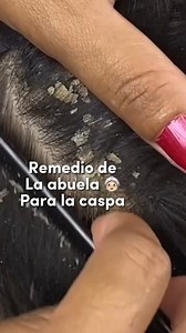 Esto podria ayudarte con la caspa #caspa #cabello #tipsdebelleza | Jess Guarin Tips de belleza