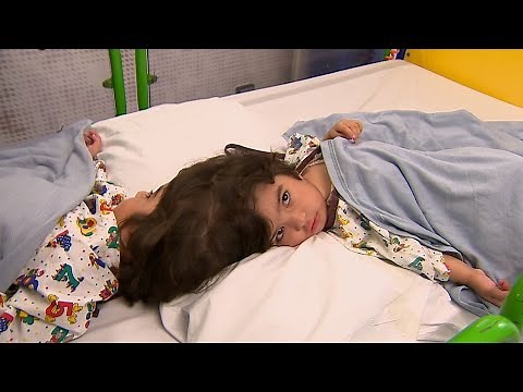 頭でつながった双子、分離手術の現場をBBCが独占取材