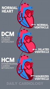 Normal Heart vs Dilated Cardiomyopathy vs Hypertrophic Cardiomyopathy #cardiology #medicalstudent #MedicalEducation #HeartHealth | Daily Cardiology