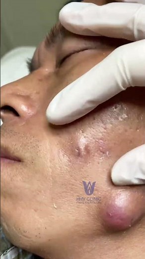 MỤN VIÊM TỤ CẦU VÙNG MÁ