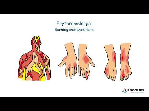 What is Erythromelalgia?