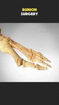 Bunion Correction Surgery (3D Animation) | Open vs Minimally Invasive Techniques #bunion #bunioncorr