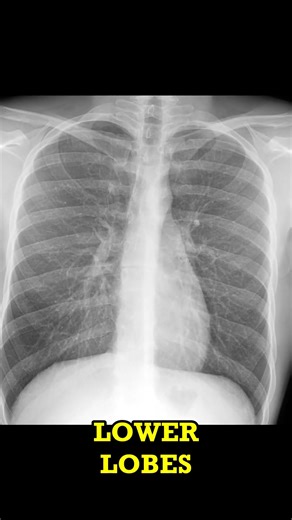 Chest X-ray Findings Bronchitis on short