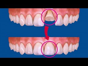 Broken Tooth Reconstruction